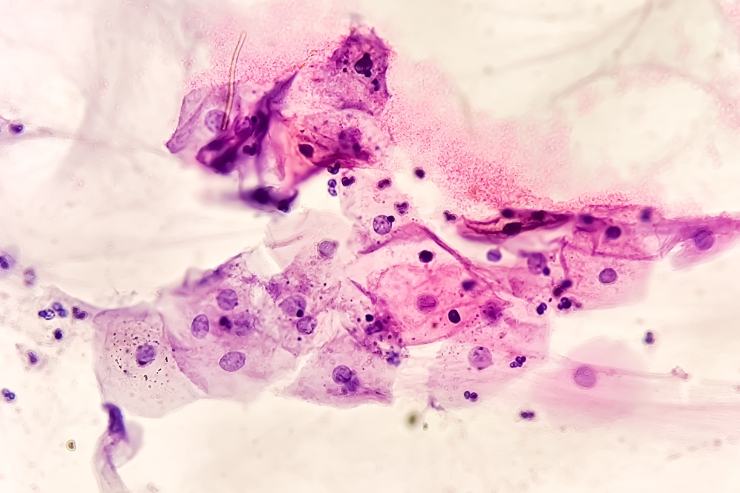 Abnormal Pap Smears-----35