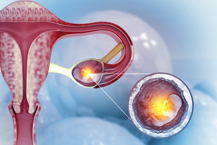 Ectopic Pregnancy-